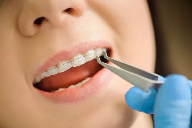 Tips to Help You Prepare Before Going to Get Veneers